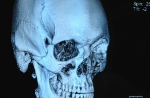 Stefan Struve Broken Jaw